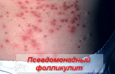 псевдомонадный фолликулит