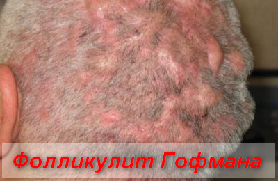 фолликулит Гофмана