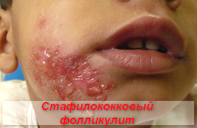 стафилококковый фолликулит