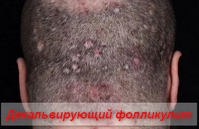 декальвирующий фолликулит