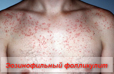 эозинофильный фолликулит