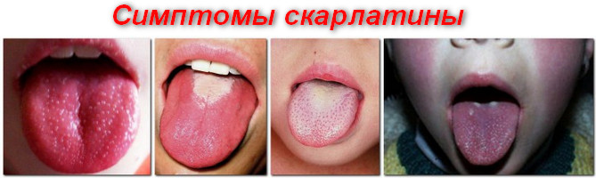 варианты симптомов скарлатины