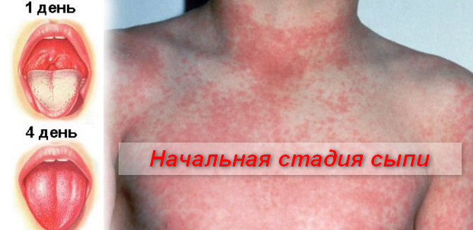 начальная стадия скарлатины