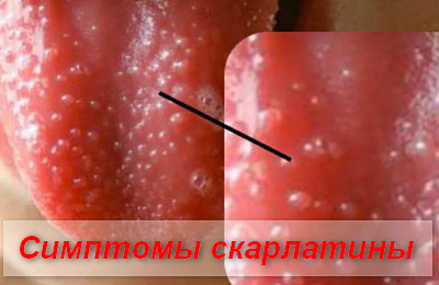 симптомы скарлатины