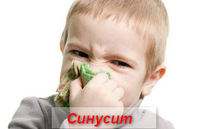 синусит