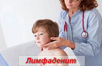 лимфаденит