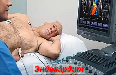 эндокардит