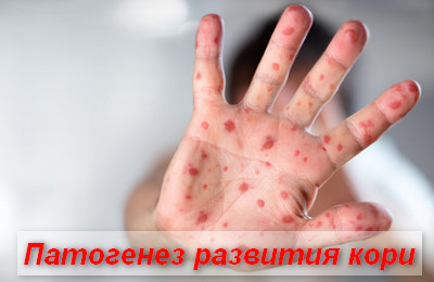 патогенез развития кори