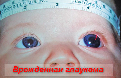 врожденная глаукома