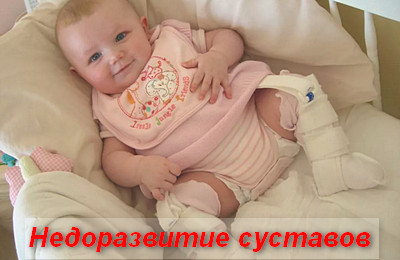недоразвитие суставов