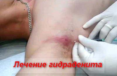 лечение гидраденита
