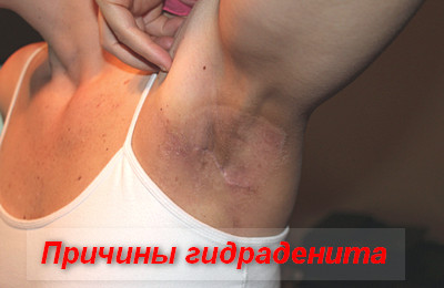 гидраденит причины
