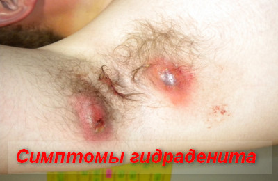 симптомы гидраденита