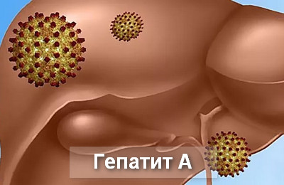 гепатит А