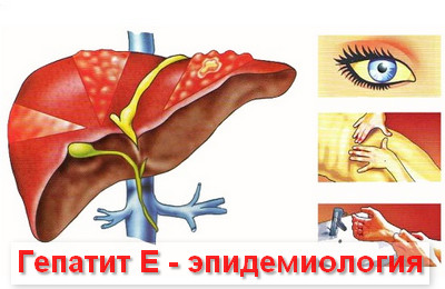 эпидемиология гепатита Е
