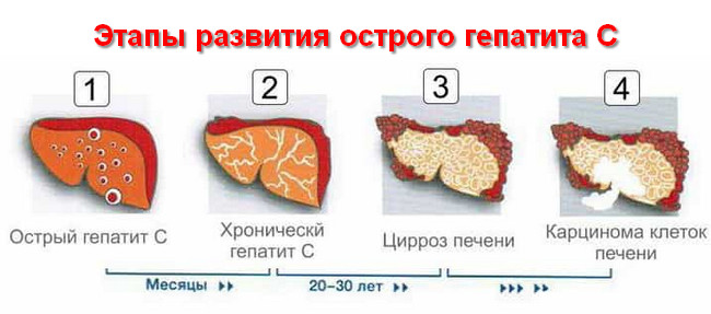 этапы развития острого гепатита С