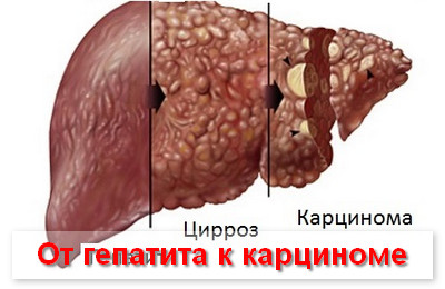 чем опасен цирроз печени