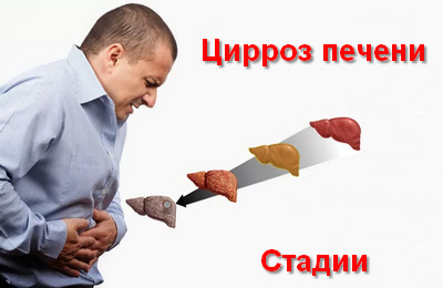 цирроз печени стадии