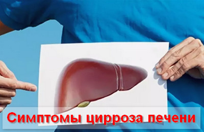 симптомы цирроза печени