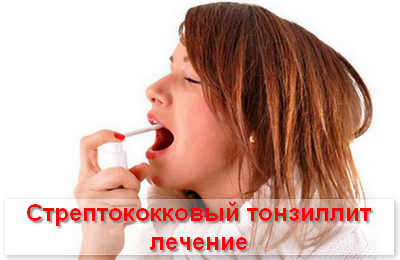 стрептококковый тонзиллит лечение