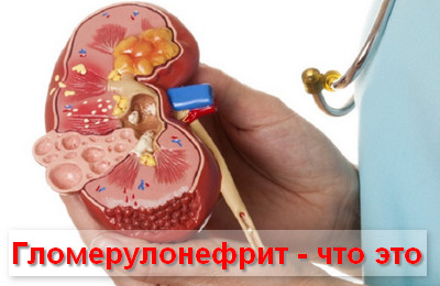 что такое гломерулонефрит