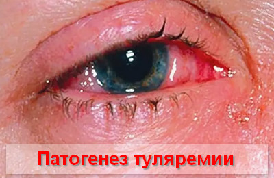 патогенез развития туляремии