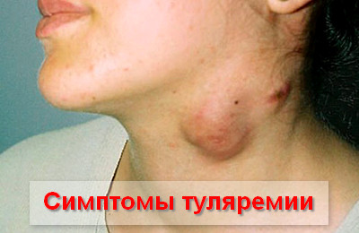 симптомы туляремии