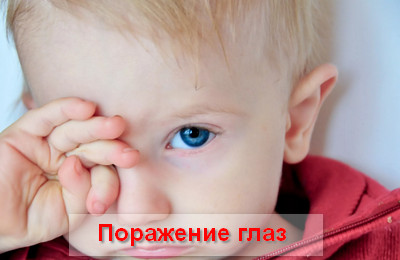 поражение глаз при аденовирусной инфекции