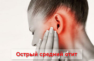 острый средний отит