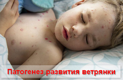 патогенез развития ветрянки