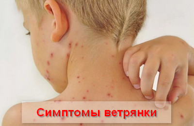 симптомы ветрянки