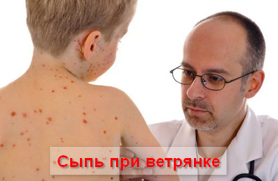 сыпь при ветрянке