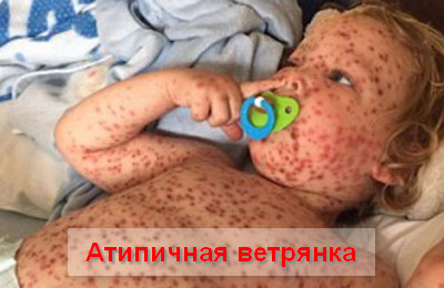 атипичная ветрянка