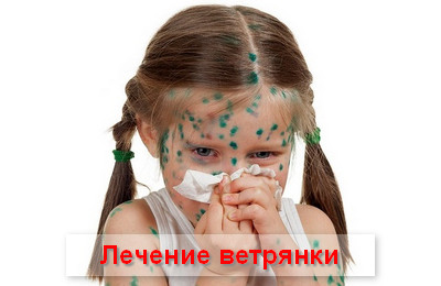 лечение ветрянки