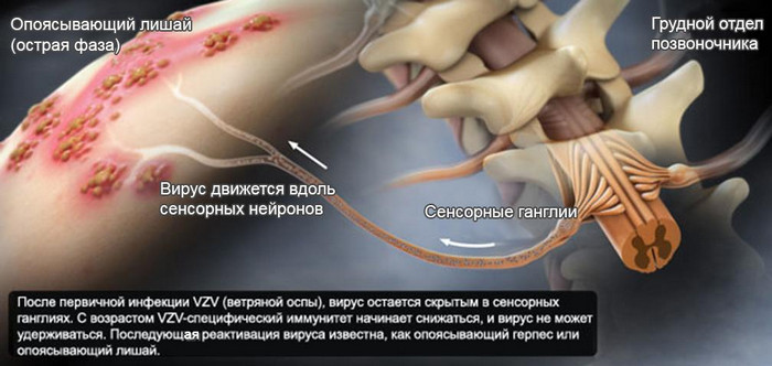 причины опоясывающего герпеса