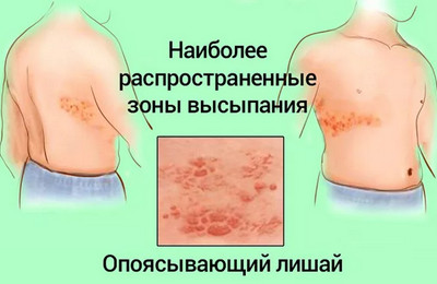 особенности опоясывающего герпеса