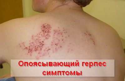 опоясывающий герпес симптомы