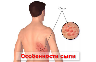 особенности сыпи