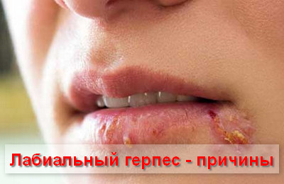 лабиальный герпес - причины