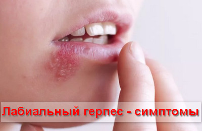 симптомы лабиального герпеса