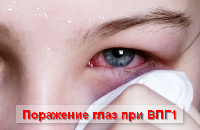 поражение глаз при ВПГ1
