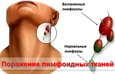 поражение лимфоидных тканей