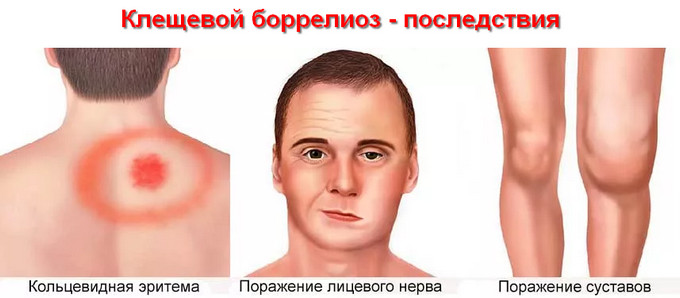клещевой боррелиоз - последствия