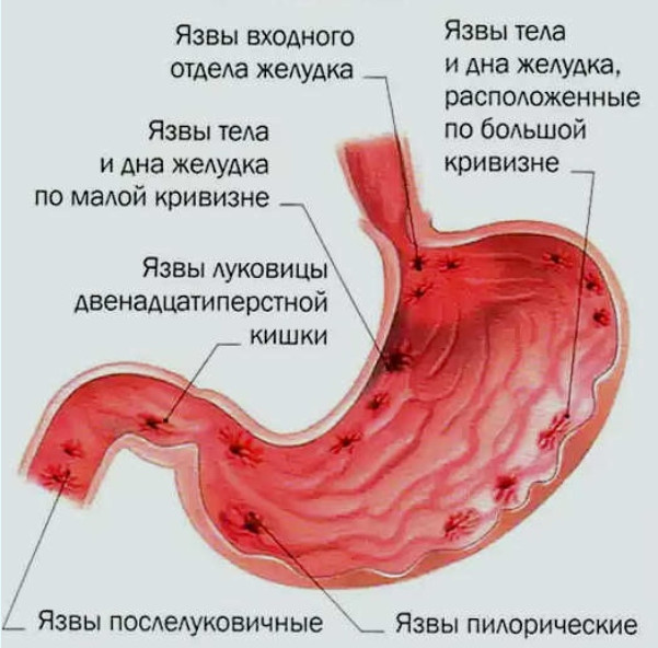 осложнения