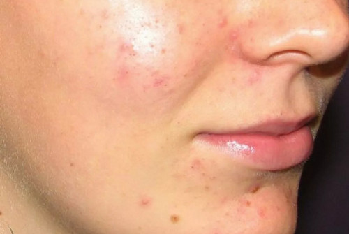 Симптомы кандидоза лица