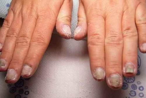 Кандидоз рук, ногтей и стоп