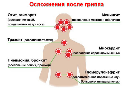 Осложнения гриппа