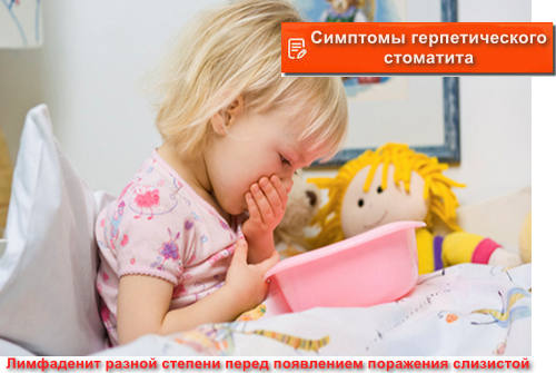 симптомы герпетического стоматита