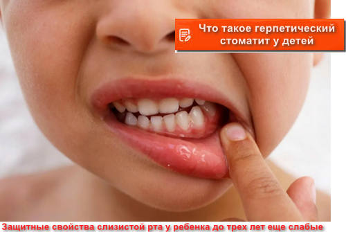 герпетический стоматит у детей - что это