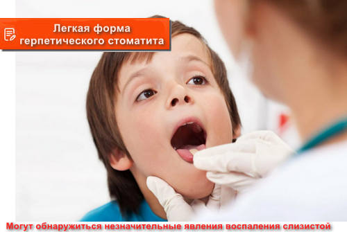 легкая форма герпетического стоматита